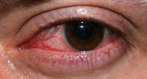 začervenanie očí - negatíva Viagry