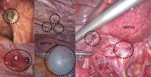 endometrióza, laparoskopický snímok