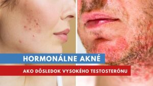 hormonálne akné