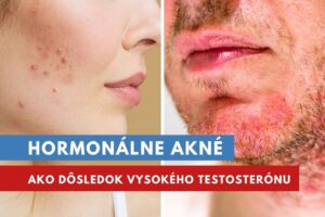 hormonálne akné